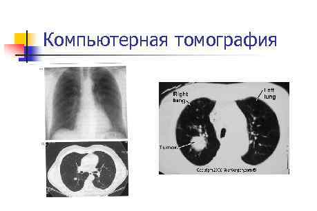 Компьютерная томография 