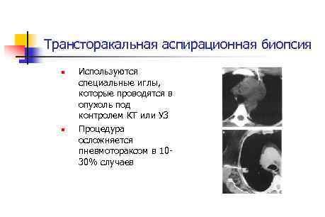 Трансторакальная аспирационная биопсия n n Используются специальные иглы, которые проводятся в опухоль под контролем