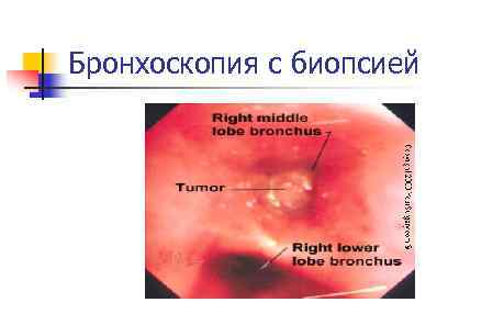Бронхоскопия с биопсией 