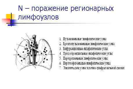 N – поражение регионарных лимфоузлов 