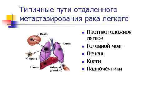 Типичные пути отдаленного метастазирования рака легкого n n n Противоположное легкое Головной мозг Печень