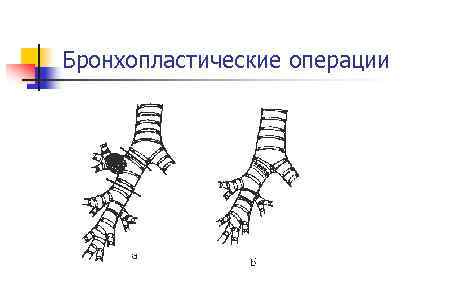 Бронхопластические операции 