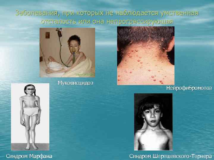 Заболевания, при которых не наблюдается умственная отсталость или она непрогрессирующая Муковисцидоз Синдром Марфана Нейрофибромотоз