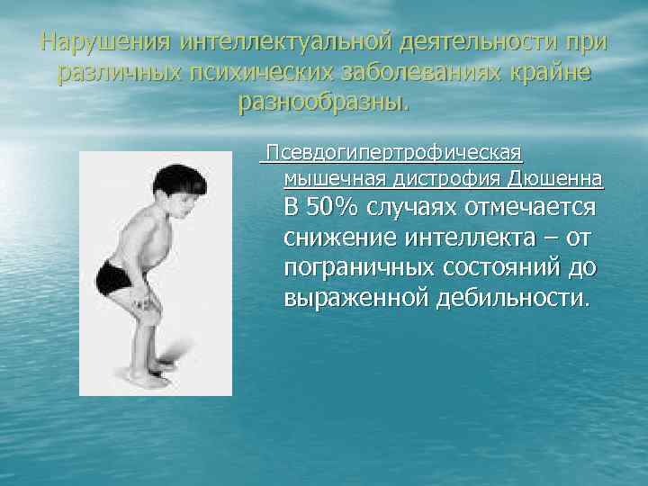 Нарушения интеллектуальной деятельности при различных психических заболеваниях крайне разнообразны. Псевдогипертрофическая мышечная дистрофия Дюшенна В