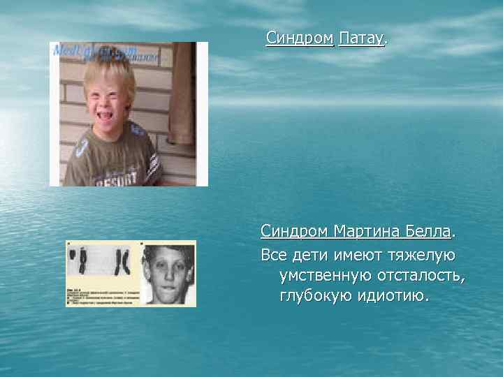 Синдром Патау. Синдром Мартина Белла. Все дети имеют тяжелую умственную отсталость, глубокую идиотию. 
