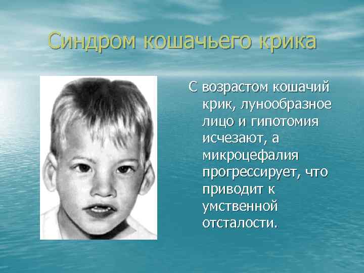 Синдром кошачьего крика С возрастом кошачий крик, лунообразное лицо и гипотомия исчезают, а микроцефалия