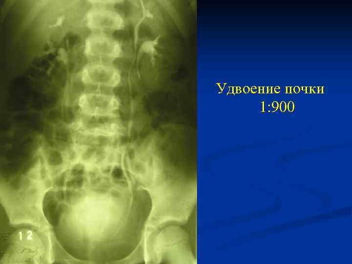 Удвоение почки. Неполное удвоение лоханки почки. Расщепление чашечно-лоханочной системы. Неполное расщепление ЧЛС. Неполное раздвоение ЧЛС.