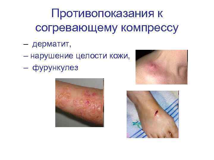 Противопоказания к согревающему компрессу – дерматит, – нарушение целости кожи, – фурункулез 