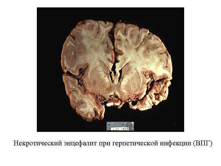 Некротический энцефалит при герпетической инфекции (ВПГ) 