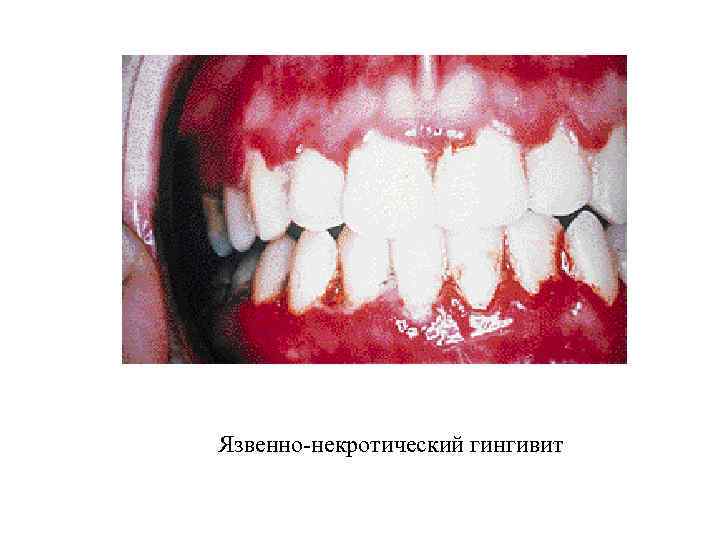 Язвенно-некротический гингивит 