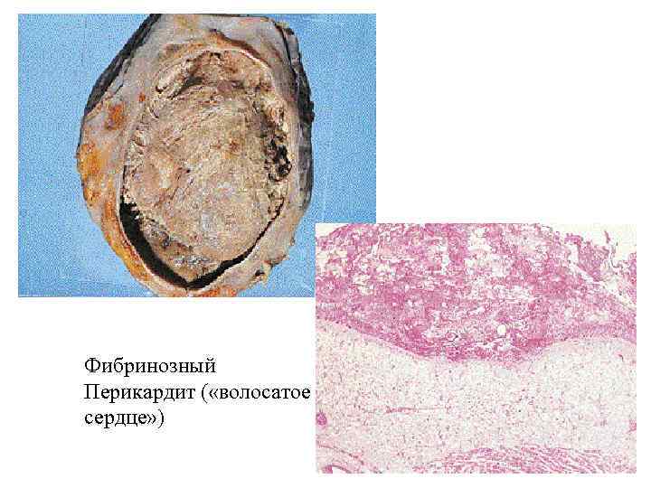Фибринозный Перикардит ( «волосатое сердце» ) 