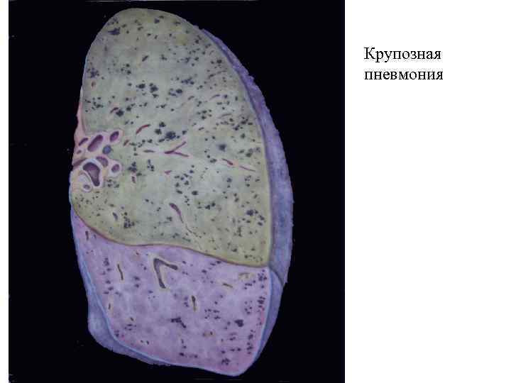 Крупозная пневмония 
