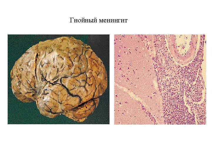 Гнойный менингит 