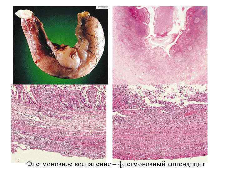 Флегмонозное воспаление – флегмонозный аппендицит 
