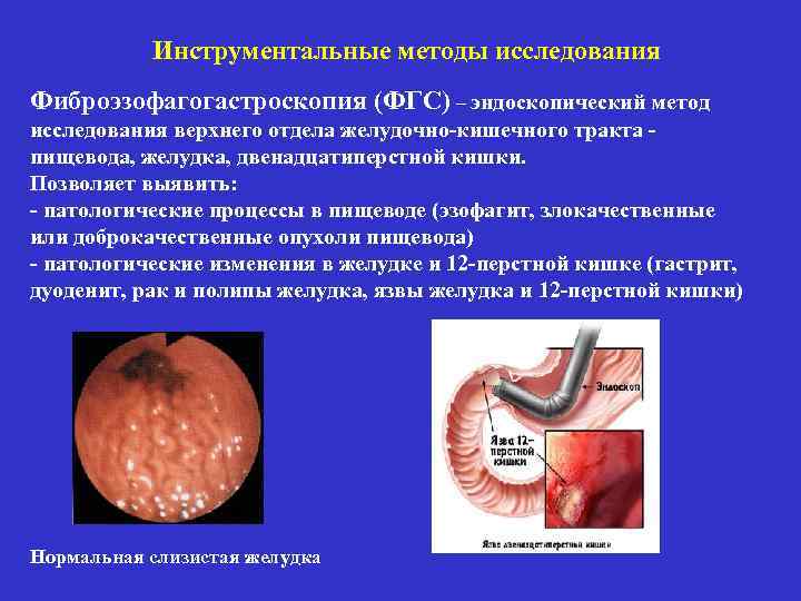 Инструментальные методы исследования Фиброэзофагогастроскопия (ФГС) – эндоскопический метод исследования верхнего отдела желудочно-кишечного тракта пищевода,