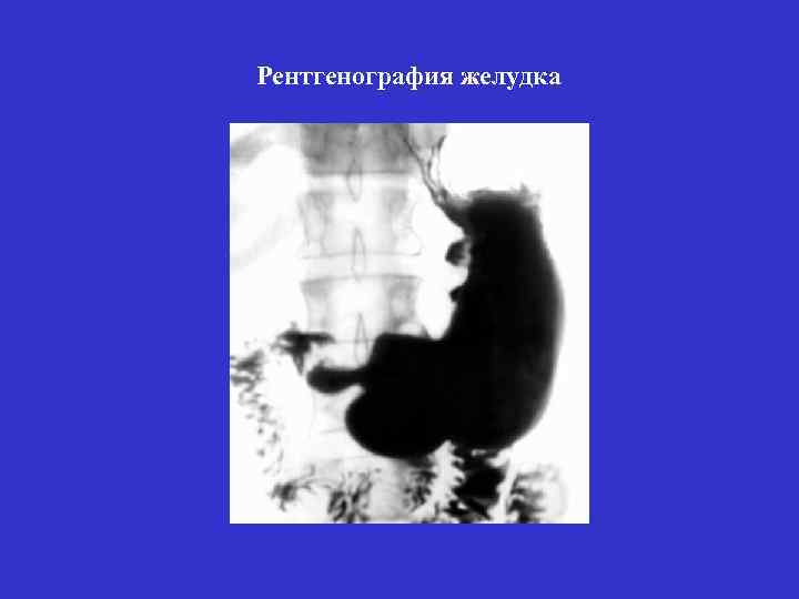 Рентгенография желудка 