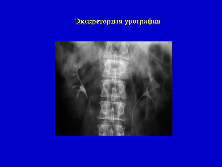 Экскреторная урография 