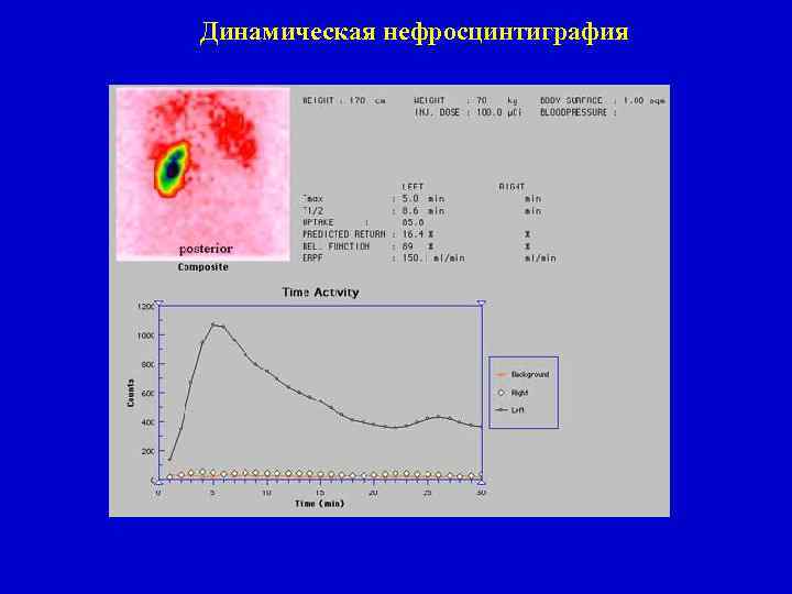 Динамическая нефросцинтиграфия 