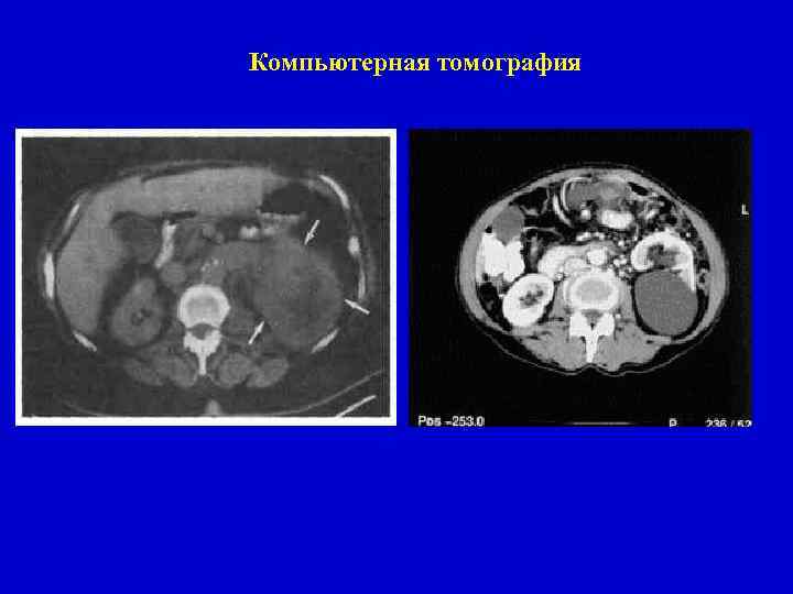 Компьютерная томография 