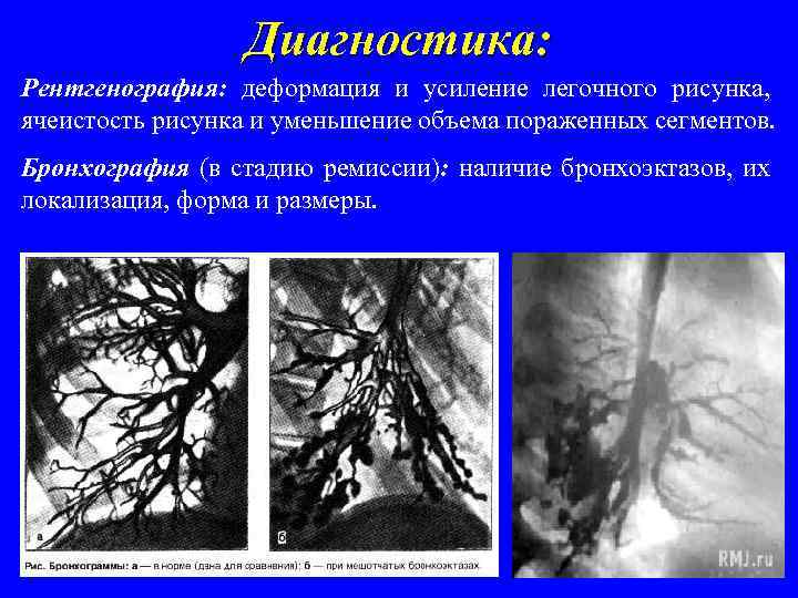 Легочный рисунок усилен деформирован