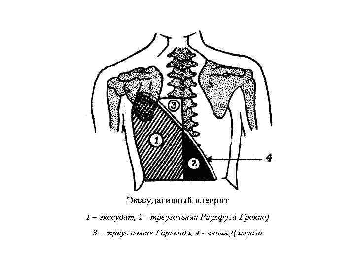  Экссудативный плеврит 1 – экссудат, 2 - треугольник Раухфуса-Грокко) 3 – треугольник Гарленда,