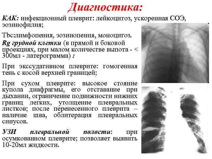 Диагностика: КАК: инфекционный плеврит: лейкоцитоз, ускоренная СОЭ, эозинофилия; Tbc: лимфопения, эозинопения, моноцитоз. Rg грудной