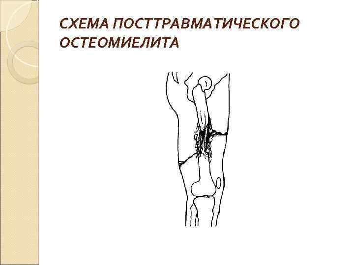 СХЕМА ПОСТТРАВМАТИЧЕСКОГО ОСТЕОМИЕЛИТА 