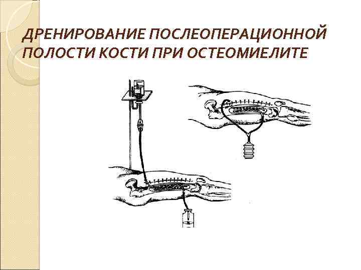 ДРЕНИРОВАНИЕ ПОСЛЕОПЕРАЦИОННОЙ ПОЛОСТИ КОСТИ ПРИ ОСТЕОМИЕЛИТЕ 