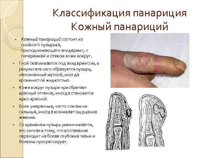 Классификация панариция Кожный панариций состоит из гнойного пузырька, приподнимающего эпидермис, с гиперемией и отеком