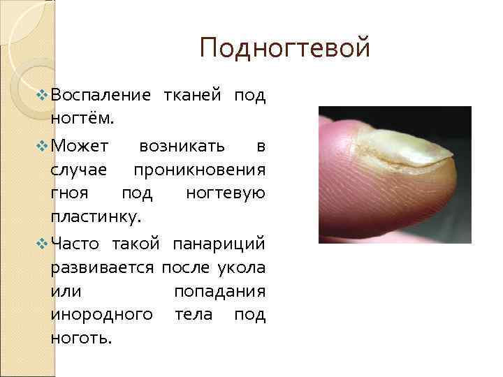 Подногтевой v Воспаление тканей под ногтём. v Может возникать в случае проникновения гноя под