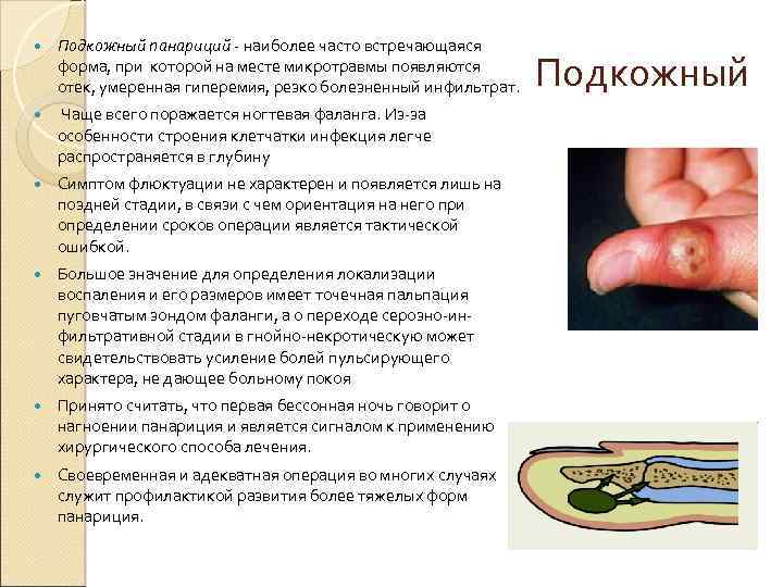  Подкожный панариций - наиболее часто встречающаяся форма, при которой на месте микротравмы появляются