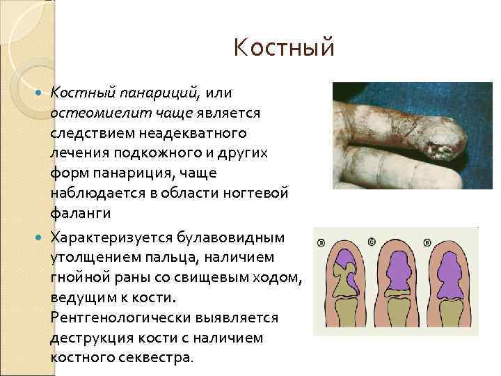 Костный панариций, или остеомиелит чаще является следствием неадекватного лечения подкожного и других форм панариция,