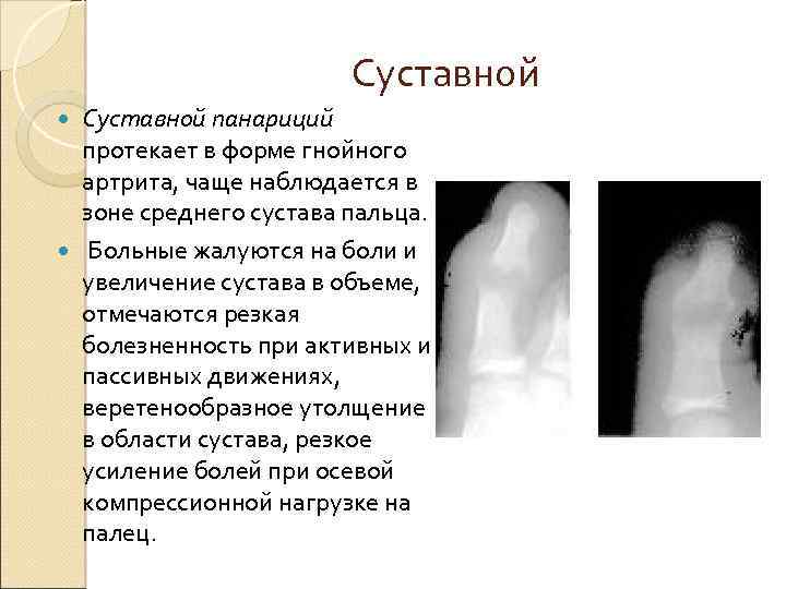 Суставной панариций протекает в форме гнойного артрита, чаще наблюдается в зоне среднего сустава пальца.