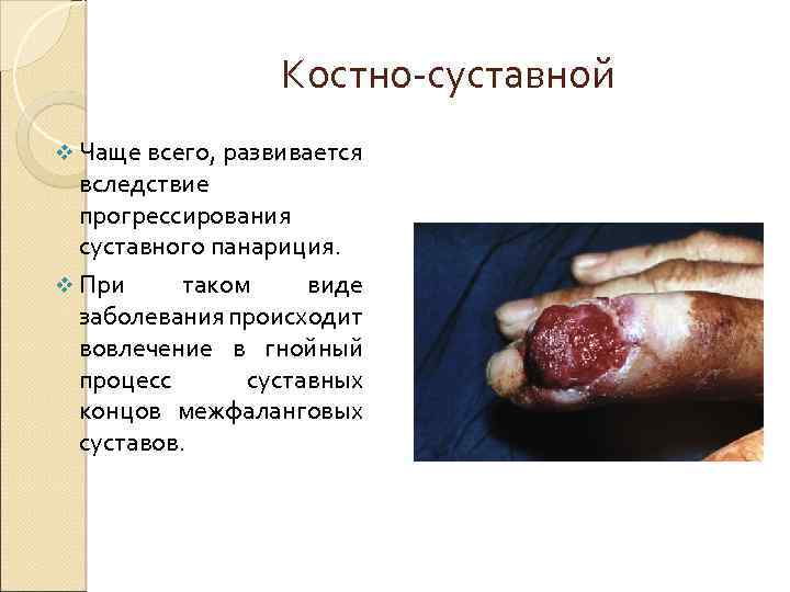Костно суставной v Чаще всего, развивается вследствие прогрессирования суставного панариция. v При таком виде