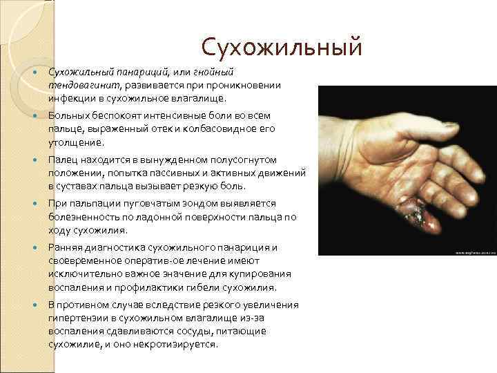 Сухожильный панариций, или гнойный тендовагинит, развивается при проникновении инфекции в сухожильное влагалище. Больных беспокоят