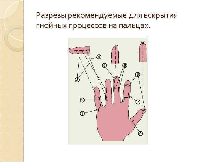 Разрезы рекомендуемые для вскрытия гнойных процессов на пальцах. 