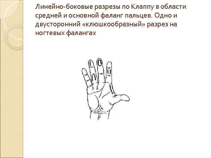 Линейно боковые разрезы по Клаппу в области средней и основной фаланг пальцев. Одно и