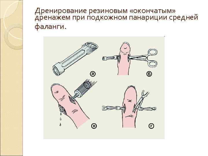 Дренирование резиновым «окончатым» дренажем при подкожном панариции средней фаланги. 