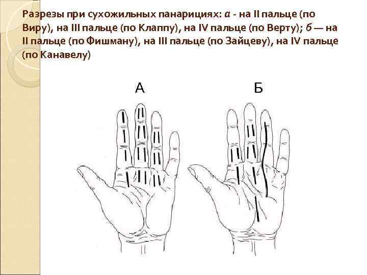 Схема разрезов при панарициях