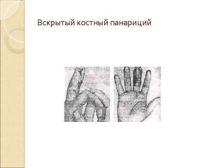 Вскрытый костный панариций 