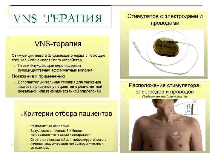 Стимулятор блуждающего нерва. VNS стимулятор. Стимуляция блуждающего нерва. VNS терапия. Блуждающий нерв эпилепсия.