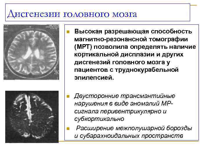 Доклад: Терапия труднокурабельной эпилепсии