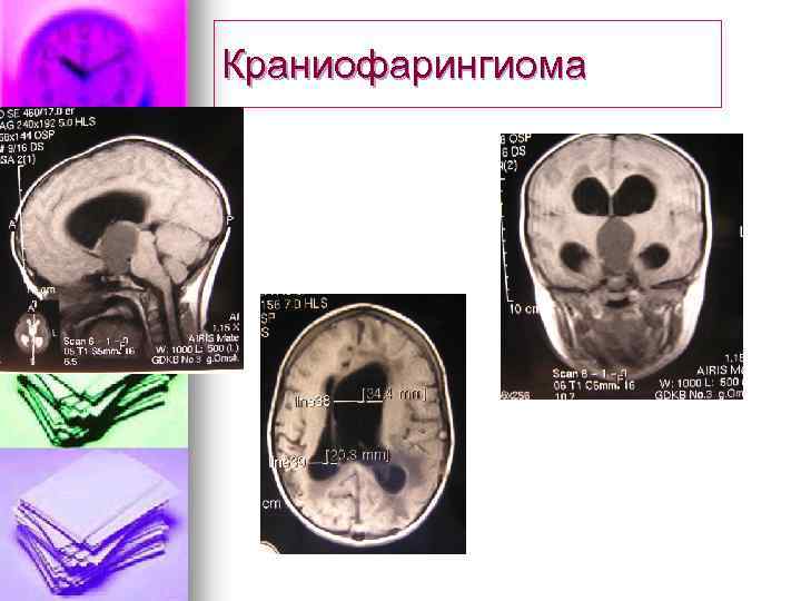 Краниофарингиома 