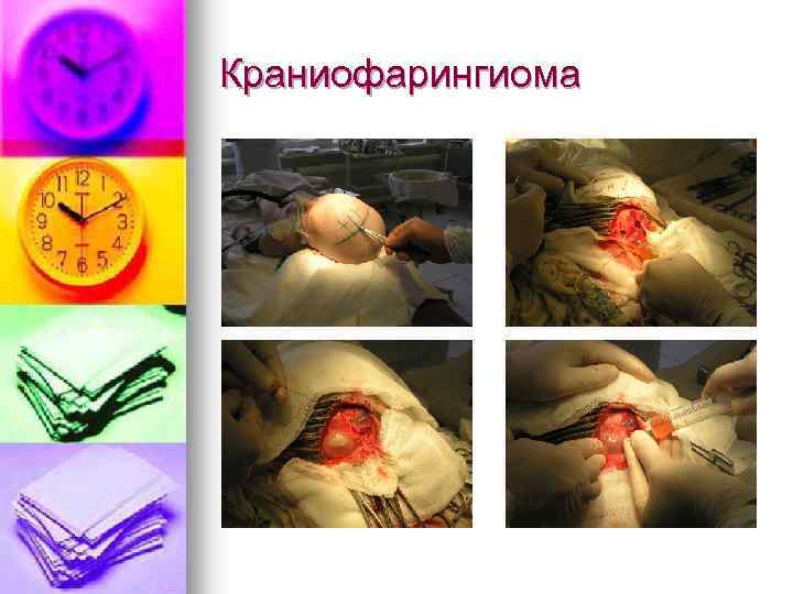 Краниофарингиома 