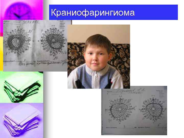 Краниофарингиома 