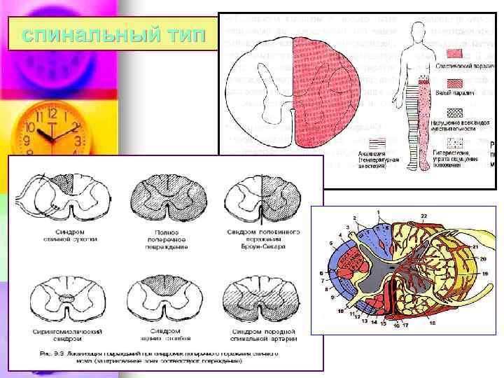 спинальный тип 