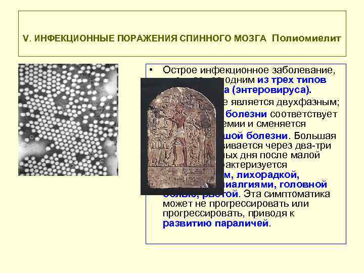 V. ИНФЕКЦИОННЫЕ ПОРАЖЕНИЯ СПИННОГО МОЗГА Полиомиелит • Острое инфекционное заболевание, вызываемое одним из трех