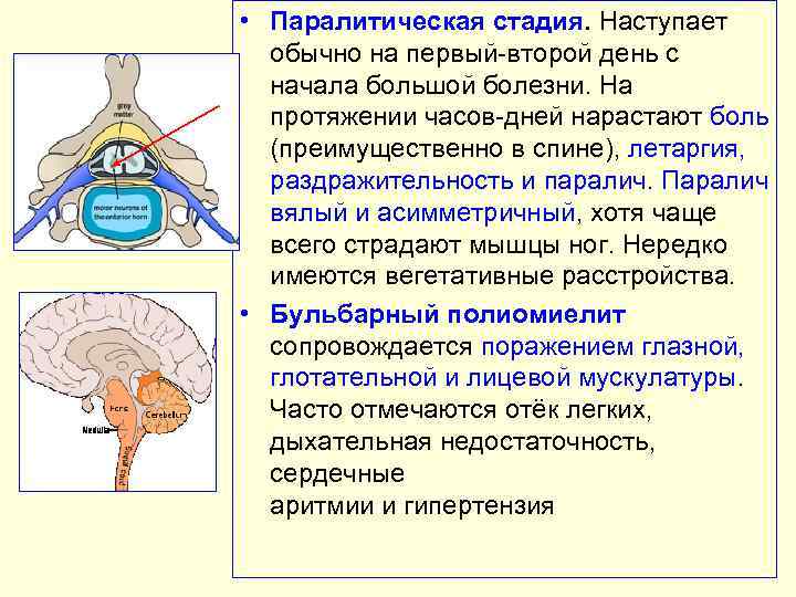  • Паралитическая стадия. Наступает обычно на первый второй день с начала большой болезни.