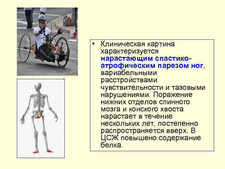  • Клиническая картина характеризуется нарастающим спастикоатрофическим парезом ног, вариабельными расстройствами чувствительности и тазовыми