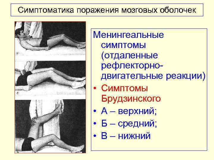 Симптоматика поражения мозговых оболочек Менингеальные симптомы (отдаленные рефлекторно двигательные реакции) • Симптомы Брудзинского •